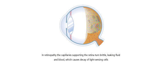 In retinopathy the capillaries supporting the retina trun brittle,…